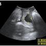 FIGURE 1: (A) A left periurethral mass extending from the left periurethral space to suburethral region measuring 3 cm x 5 cm; (B) Midsagittal view of the pelvic floor showing a cystic mass (*) dorsal to the urethra (U) measuring 2.17 cm x 2.78 cm on translabial perineal ultrasound (TPUS); (C) TPUS view demonstrating a periurethral mass dorsal to the urethra measuring 4.22 cm (width) x 1.99 cm (vertical dimension). (SP: Symphysis pubis; Ut: Uterus; CX: Cervix)