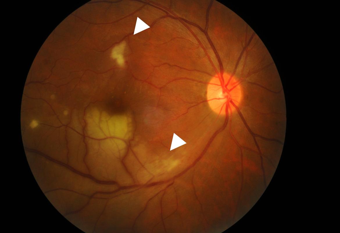 FIGURE 1: Colored fundus photograph of the right eye showed a BRAO involving the inferotemporal arcade (inferior arrow) with surrounding pallid retinal edema associated with an area of focal retinitis (superior arrow)