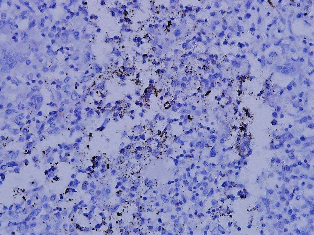 Positive NFATc1 from a 16-year-old boy with osteoblastic osteosarcoma distal femur. After the surgical resection, he underwent 6 courses chemotherapy with 95% necrosis. NFATc1 was found to be positive as shown, and he survived 10 years disease free (NFATc1: Nuclear factor of activated T cells c1)