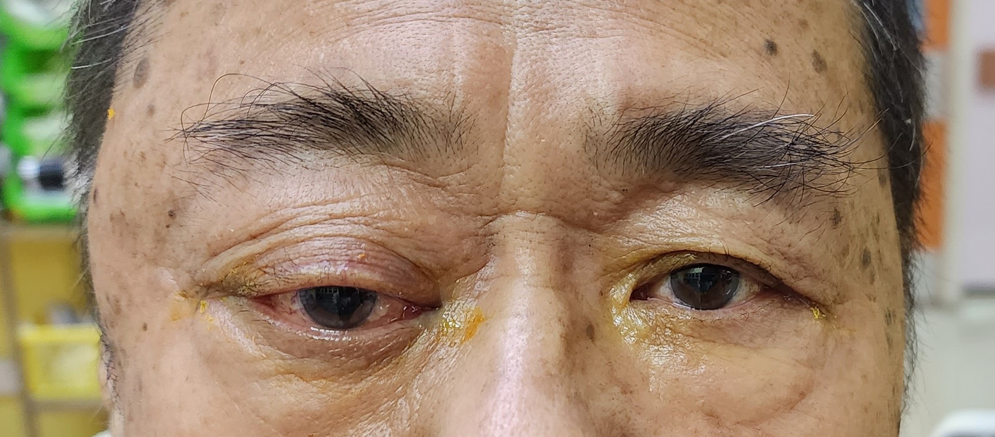 Photo of case 1 showed right eye redness, proptosis and temporal scalp swelling