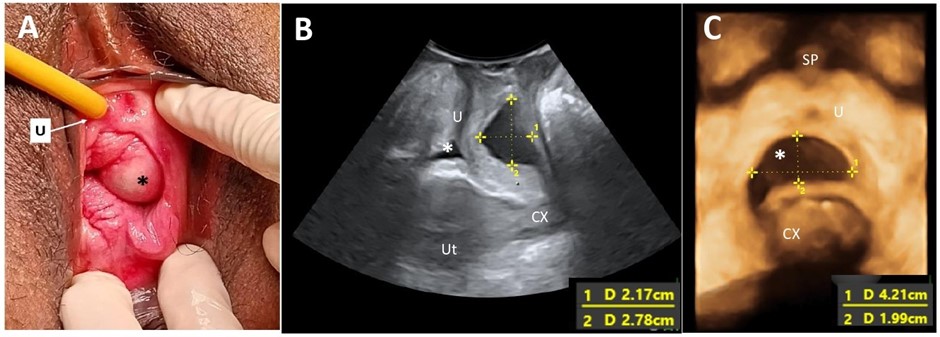 FIGURE 1: (A) A left periurethral mass extending from the left periurethral space to suburethral region measuring 3 cm x 5 cm; (B) Midsagittal view of the pelvic floor showing a cystic mass (*) dorsal to the urethra (U) measuring 2.17 cm x 2.78 cm on translabial perineal ultrasound (TPUS); (C) TPUS view demonstrating a periurethral mass dorsal to the urethra measuring 4.22 cm (width) x 1.99 cm (vertical dimension). (SP: Symphysis pubis; Ut: Uterus; CX: Cervix)