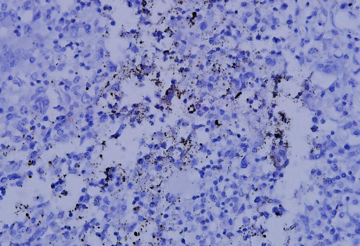 Positive NFATc1 from a 16-year-old boy with osteoblastic osteosarcoma distal femur. After the surgical resection, he underwent 6 courses chemotherapy with 95% necrosis. NFATc1 was found to be positive as shown, and he survived 10 years disease free (NFATc1: Nuclear factor of activated T cells c1)