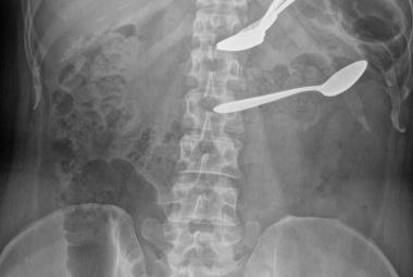 Foreign bodies in the stomach and transverse colon on abdominal X-ray