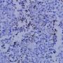Positive NFATc1 from a 16-year-old boy with osteoblastic osteosarcoma distal femur. After the surgical resection, he underwent 6 courses chemotherapy with 95% necrosis. NFATc1 was found to be positive as shown, and he survived 10 years disease free (NFATc1: Nuclear factor of activated T cells c1)