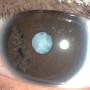 FIGURE 1: Photo of left eye showing sectoral iridoschisis and a dense white cataract