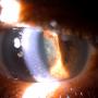 Anterior segment of the left eye with keratic precipitates, seclusio pupillae and dense cataracts