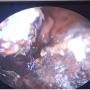 Right nasoendoscopic finding of eschar over the septum (blue arrow) and inferior turbinate (yellow arrow)